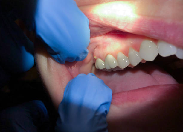 Best Emergency Wisdom Teeth Removal in Latimer, MS